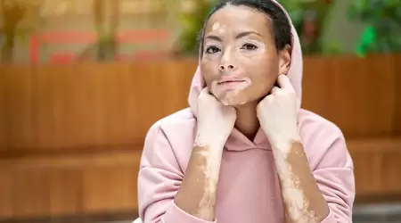 10 Bahan Herbal Alami untuk Membantu Mengatasi Vitiligo